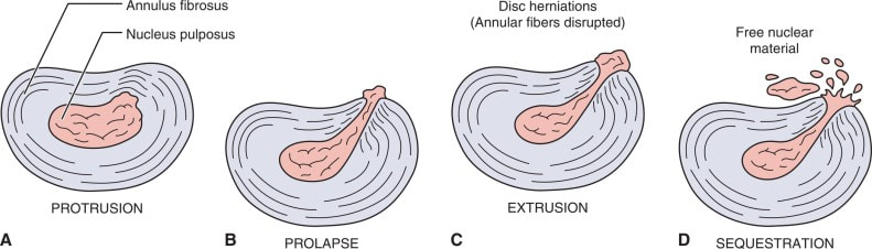pictures showing different stages of slipped discs
