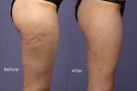 cellulite treatment before and after 