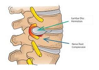 herniated disc impinging a nerve 